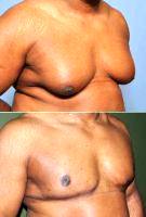 Doctor Barry L. Eppley, MD, DMD, Indianapolis Plastic Surgeon 50 Year Old Male Treated For Severe Gynecomastia