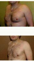Doctor Gregory Turowski, MD, PhD, FACS, Chicago Plastic Surgeon 37 Year Old Man Treated With Male Breast Reduction