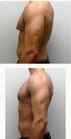 Doctor Jay M. Pensler, MD, Chicago Plastic Surgeon 38 Year Old Man Treated With Male Breast Reduction