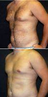 Doctor Jeffrey D. Wagner, MD, Indianapolis Plastic Surgeon 28 Year Old Man Treated With Male Breast Reduction