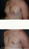 Doctor Semira Bayati, MD, FACS, Orange County Plastic Surgeon Male Breast Reduction Before After (2)