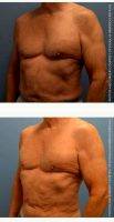 Dr Douglas Hendricks, MD, Newport Beach Plastic Surgeon Male Breast Reduction
