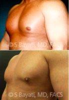 Dr Semira Bayati, MD, FACS, Orange County Plastic Surgeon Male Breast Reduction Before And After (1)