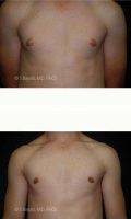 Dr Semira Bayati, MD, FACS, Orange County Plastic Surgeon Male Breast Reduction Images (1)