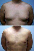 Dr. Amy T. Bandy, DO, FACS, Newport Beach Plastic Surgeon Gynecomastia-Male Breast Reduction