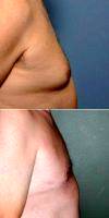 Dr. Barry L. Eppley, MD, DMD, Indianapolis Plastic Surgeon 53 Year Old Man Treated With Male Breast Reduction