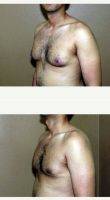 Dr. Gregory Turowski, MD, PhD, FACS, Chicago Plastic Surgeon 28 Year Old Man Treated With Male Breast Reduction