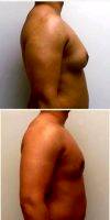 Dr. Jay M. Pensler, MD, Chicago Plastic Surgeon 28 Year Old Man Treated With Male Breast Reduction