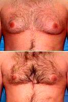 Dr. Sandeep Jejurikar, MD, Chicago Plastic Surgeon Gynecomastia Male Breast Reduction