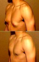 Gynecomastia - Male Breast Enlargement Correction (reduction) By Dr. Gregory Turowski, MD, PhD, FACS, Chicago Plastic Surgeon