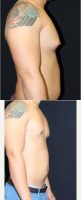 22 Year Old Man Treated With Male Breast Reduction  With Doctor Kris M. Reddy, MD, FACS, West Palm Beach Plastic Surgeon
