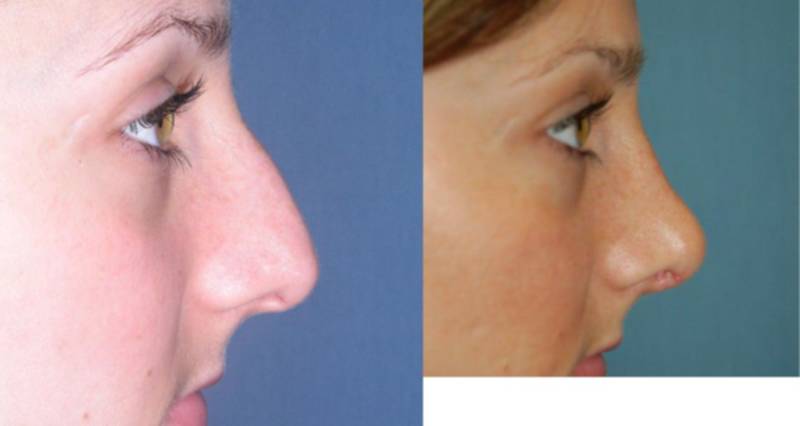 28 Year Old Female Treated With Rhinoplasty Nose Patient