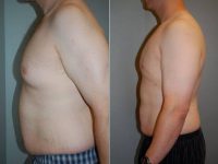 29 Year Old Man Treated With Male Breast Reduction  With Dr Glen Brooks, MD, Springfield Plastic Surgeon