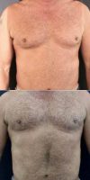 46 Year Old Man Treated With Male Breast Reduction  With Dr. Alex Campbell, MD, Colombia Plastic Surgeon