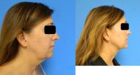 45-54 year old woman treated with PrecisionTx