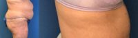 55-64 year old woman treated with Tummy Tuck