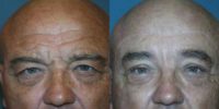 65-74 year old man treated with Forehead Lift