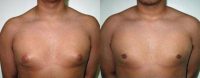 Adolescent Male treated for Breast Reduction