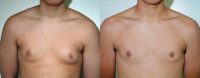 Adolescent Male treated for Breast Reduction