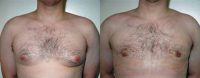 Adult Male treated for Breast Reduction