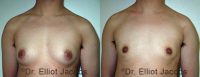 Female to Male Chest Masculinization Surgery