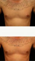 Doctor George Toledo, MD, Dallas Plastic Surgeon 23 Year Old Man Treated With Male Breast Reduction