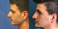 25-34 year old man treated with Nose Surgery