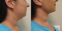25-34 year old woman treated with Neck Liposuction