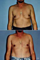 Dr Andrew Kaczynski, MD , Sacramento Plastic Surgeon Male Breast Reduction