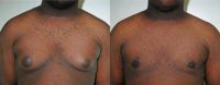 Adult Male treated for Breast Reduction