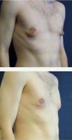 Dr Marshall T. Partington, MD, FACS, Seattle Plastic Surgeon Male Breast Reduction