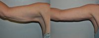 Dr. Marc Malek Arm Lift (Brachioplasty) Patient
