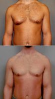 Dr. Mathew C. Mosher, MD, Vancouver Plastic Surgeon Breast Reduction