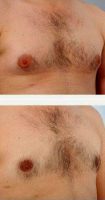 Dr. Paul Vitenas, Jr., MD, Houston Plastic Surgeon Male Breast Reduction