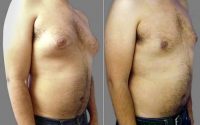 Male, Early 40s, Gynecomastia  By Doctor Phillip R. Craft, MD, Miami Plastic Surgeon