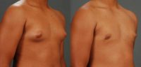 Man treated with Male Breast Reduction