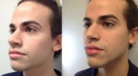18-24 year old man treated with Lip Fillers