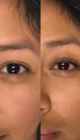 18-24 year old woman treated with Lash Lift