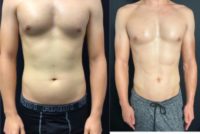 25-34 year old man treated with Liposuction