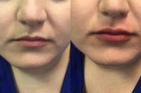 25-34 year old woman treated with Restylane Refyne
