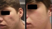 25-34 year old man treated with Retin-A, Accutane