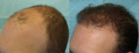 25-34 year old man treated with Hair Transplant