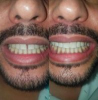 25-34 year old man treated with Dental Bonding