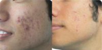 25-34 year old man treated with Spironolactone For Acne, Laser Resurfacing, CO2 Laser, YAG Laser, Fractional Laser, UltraPulse C