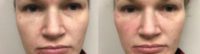 25-34 year old woman treated with Injectable Fillers