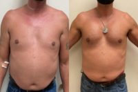 25-34 year old man treated with Pec Implants