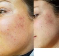 25-34 year old woman treated with Vi Peel