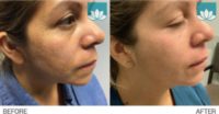 35-44 year old woman treated with Skin Lightening