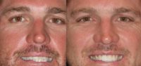 40 year old man treatment smile makeover