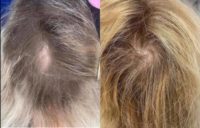 35-44 year old woman treated with Hair Loss Treatment